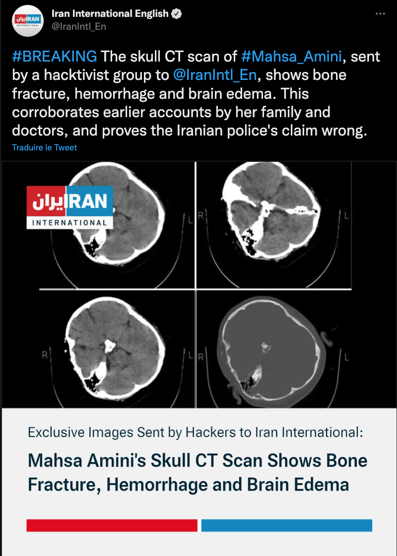 Traduction : «&nbspLe scanner crânien de Mahsa Amini, envoyé par un groupe de "hacktivistes" à Iran International, montre une fracture du crâne, une hémorrhagie et un œdème cérébral. Cela corrobore les thèses de la famille et des médecins, et prouve que les assertions de la police iranienne sont fausses. » 